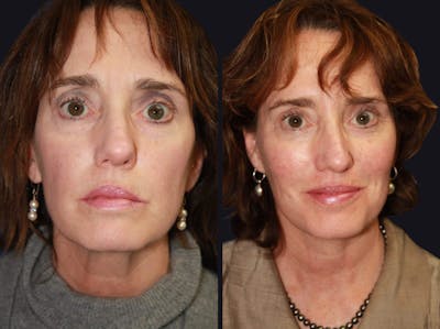 Facelift Before & After Gallery - Patient 177928461 - Image 1