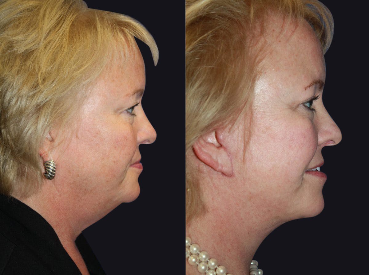 Facelift Before & After Gallery - Patient 177928455 - Image 1