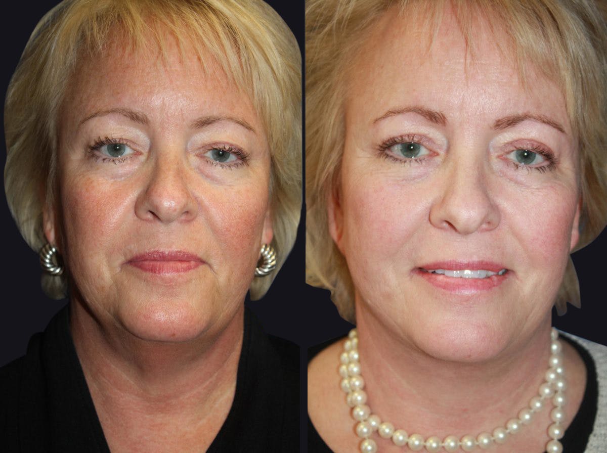 Facelift Before & After Gallery - Patient 177928455 - Image 2