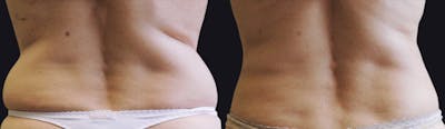 Coolsculpting Before & After Gallery - Patient 177928450 - Image 1