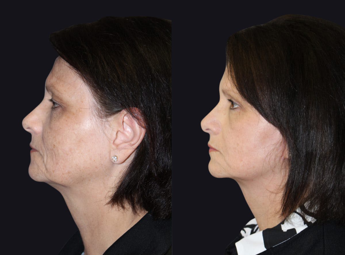 Facelift Before & After Gallery - Patient 177928445 - Image 1