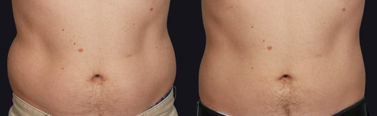 Coolsculpting Before & After Gallery - Patient 177928440 - Image 1