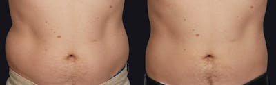 Coolsculpting Before & After Gallery - Patient 177928440 - Image 1