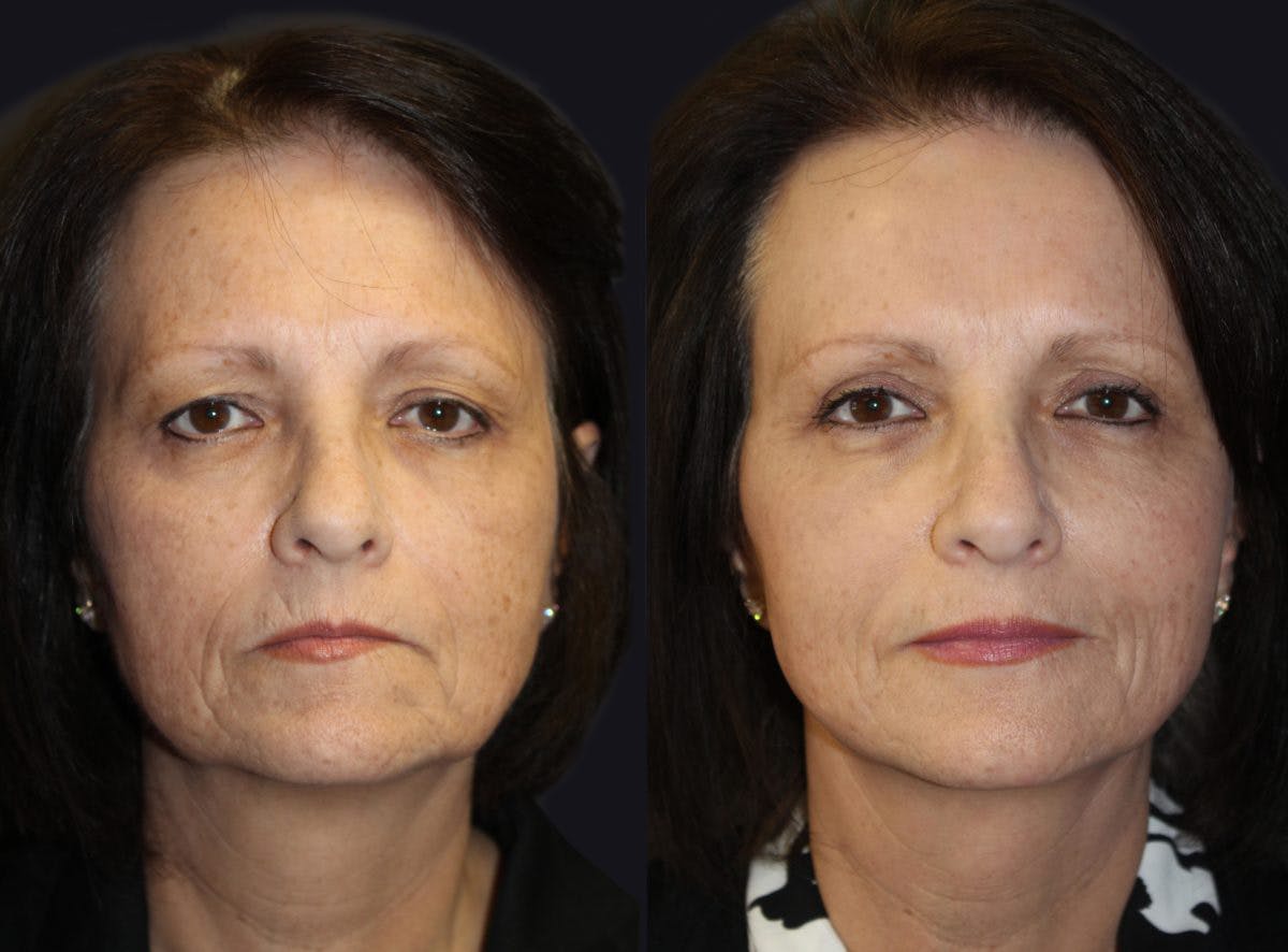 Facelift Before & After Gallery - Patient 177928445 - Image 2