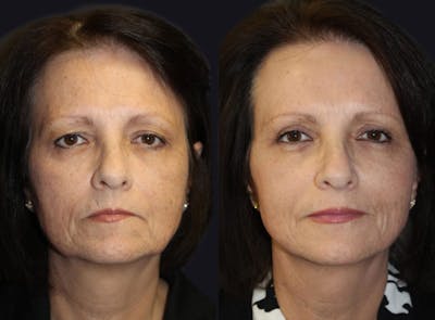 Facelift Before & After Gallery - Patient 177928445 - Image 1