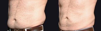 Coolsculpting Before & After Gallery - Patient 177928438 - Image 1