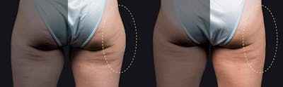 Coolsculpting Before & After Gallery - Patient 177928436 - Image 1