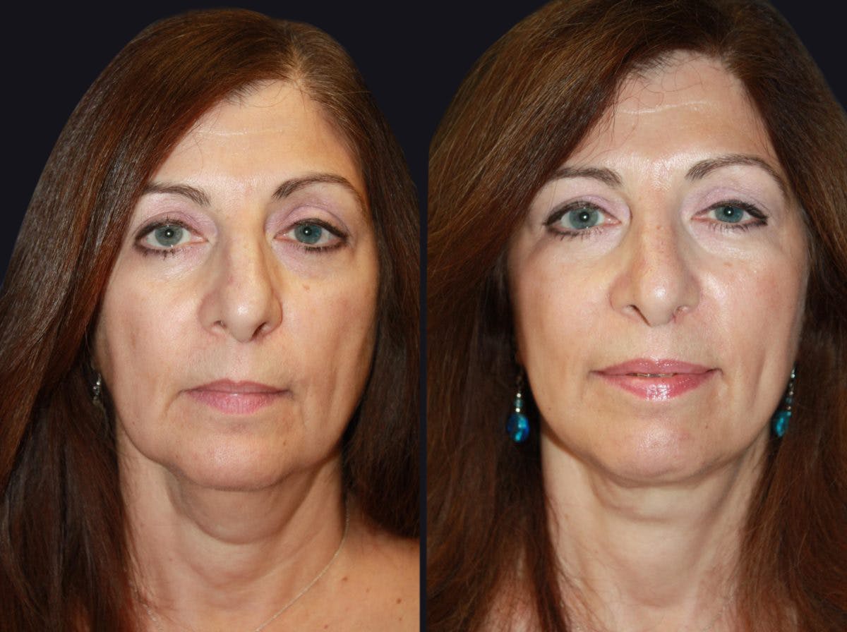 Facelift Before & After Gallery - Patient 177928437 - Image 2