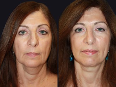 Facelift Before & After Gallery - Patient 177928437 - Image 1