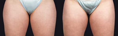 Coolsculpting Before & After Gallery - Patient 177928435 - Image 1