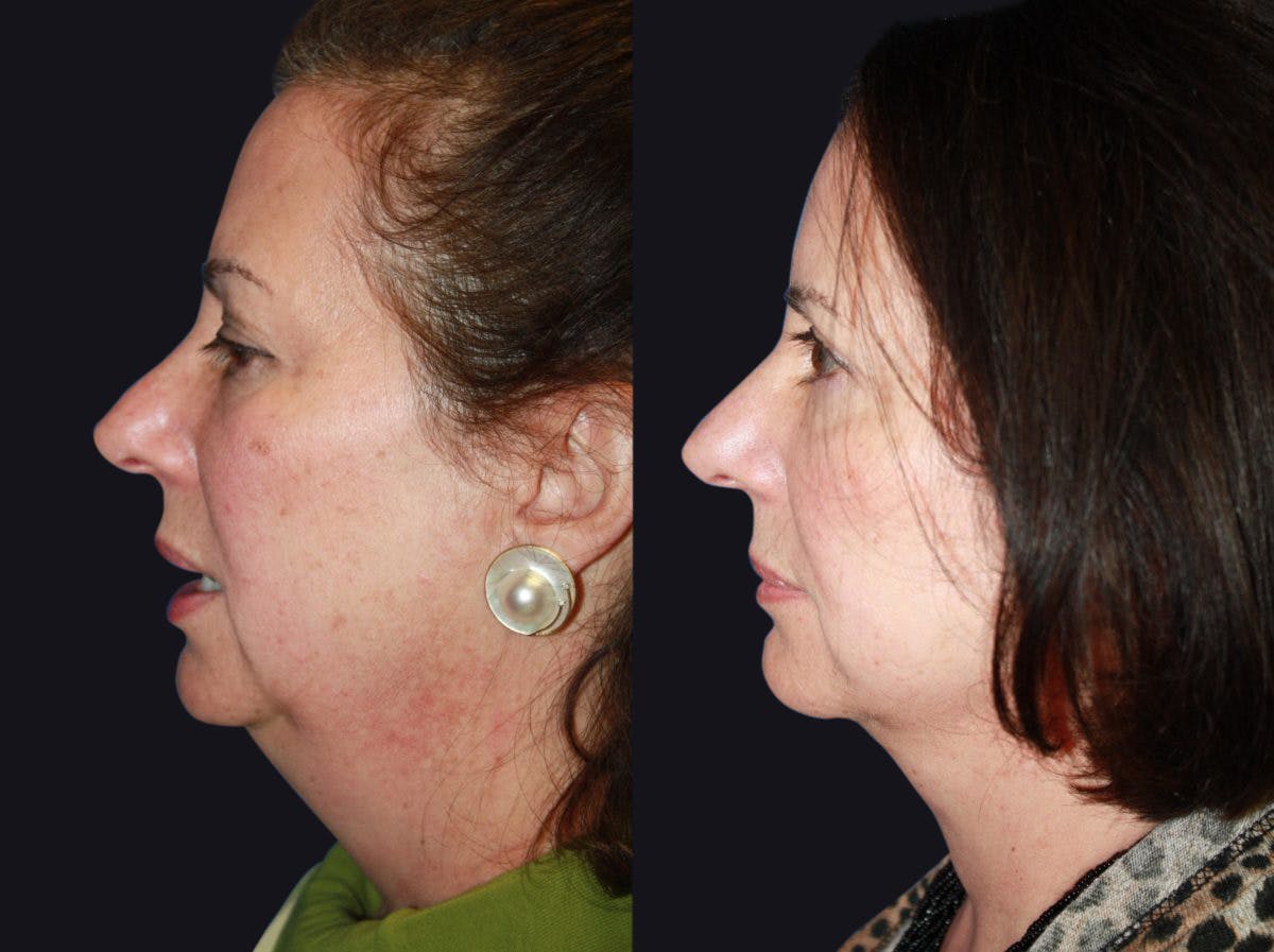 Facelift Before & After Gallery - Patient 177928434 - Image 1