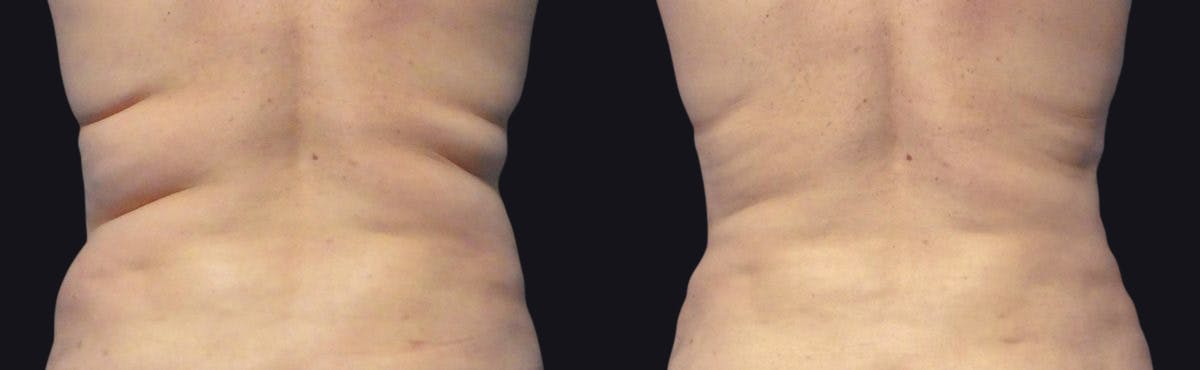 Coolsculpting Before & After Gallery - Patient 177928418 - Image 1