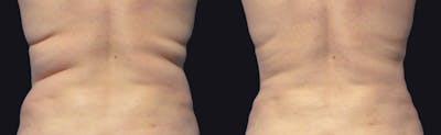Coolsculpting Before & After Gallery - Patient 177928418 - Image 1