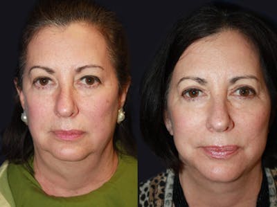 Facelift Before & After Gallery - Patient 177928434 - Image 1