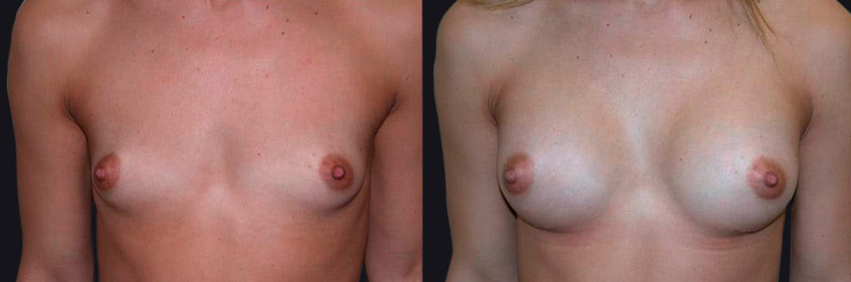 Breast Augmentation Before & After Gallery - Patient 177928417 - Image 1