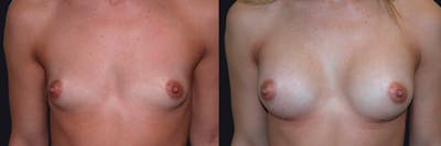 Breast Augmentation Before & After Gallery - Patient 177928417 - Image 1
