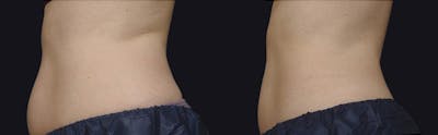 Coolsculpting Before & After Gallery - Patient 177928416 - Image 1