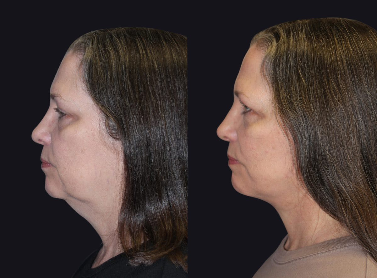 Facelift Before & After Gallery - Patient 177928415 - Image 1