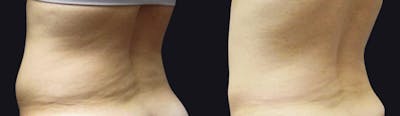 Coolsculpting Before & After Gallery - Patient 177928414 - Image 1