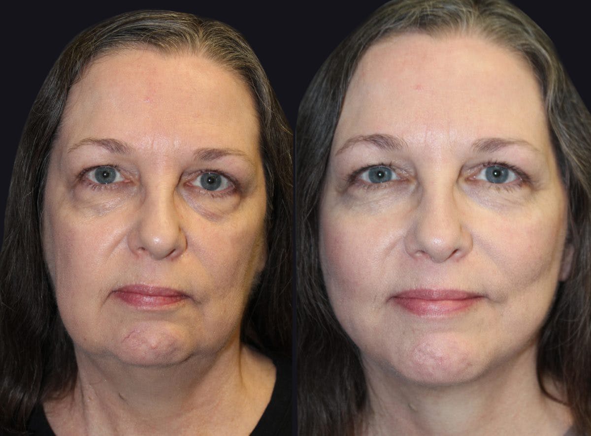 Facelift Before & After Gallery - Patient 177928415 - Image 2