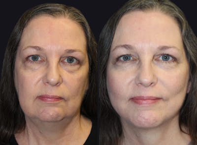 Facelift Before & After Gallery - Patient 177928415 - Image 1