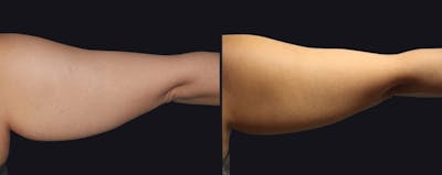 Coolsculpting Before & After Gallery - Patient 177928413 - Image 1