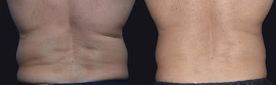 Coolsculpting Before & After Gallery - Patient 177928410 - Image 1
