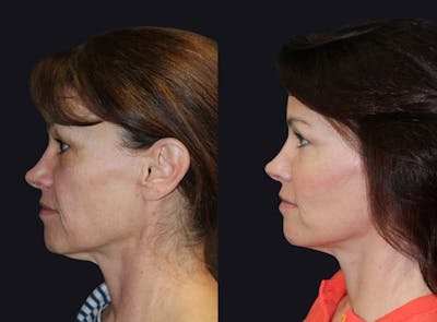 Facelift Before & After Gallery - Patient 177928406 - Image 1