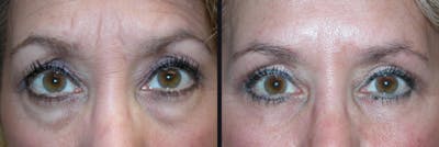 Blepharoplasty Before & After Gallery - Patient 177928401 - Image 1