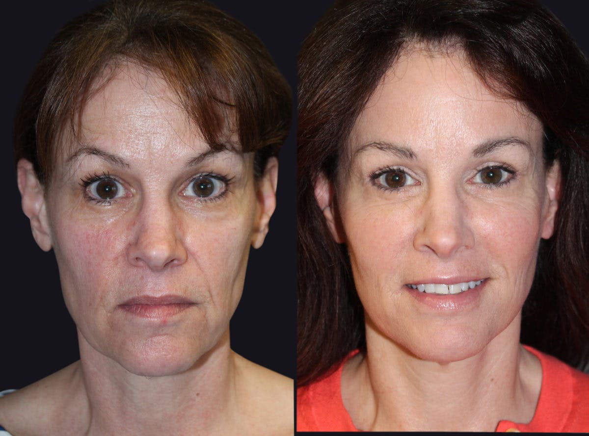 Facelift Before & After Gallery - Patient 177928406 - Image 2