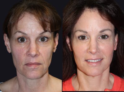 Facelift Before & After Gallery - Patient 177928406 - Image 1