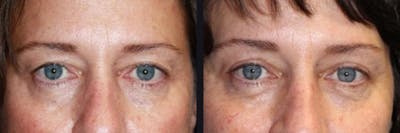 Blepharoplasty Before & After Gallery - Patient 177928398 - Image 1