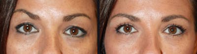 Blepharoplasty Before & After Gallery - Patient 177928393 - Image 1