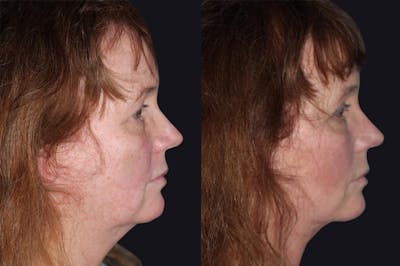 Facelift Before & After Gallery - Patient 177928392 - Image 1