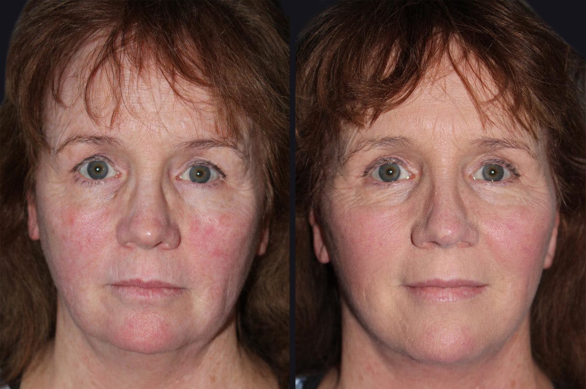Facelift Before & After Gallery - Patient 177928392 - Image 2