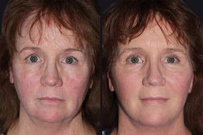 Facelift Before & After Gallery - Patient 177928392 - Image 1
