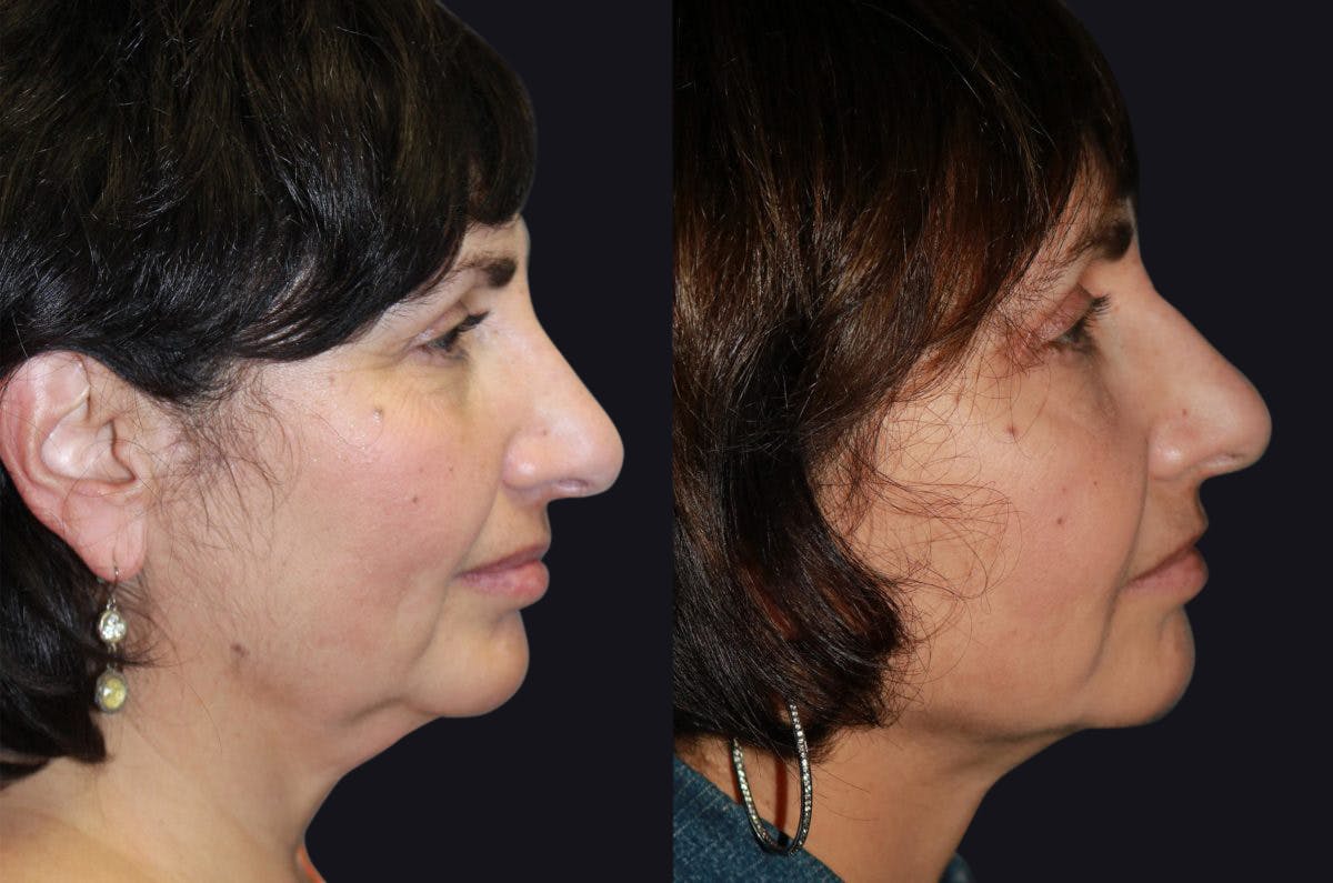 Neck Liposuction Before & After Gallery - Patient 177928383 - Image 1