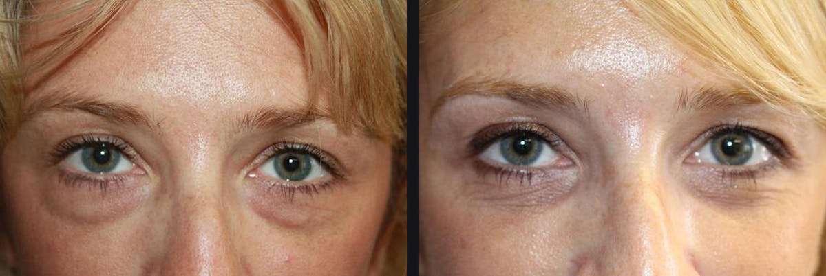 Blepharoplasty Before & After Gallery - Patient 177928384 - Image 1
