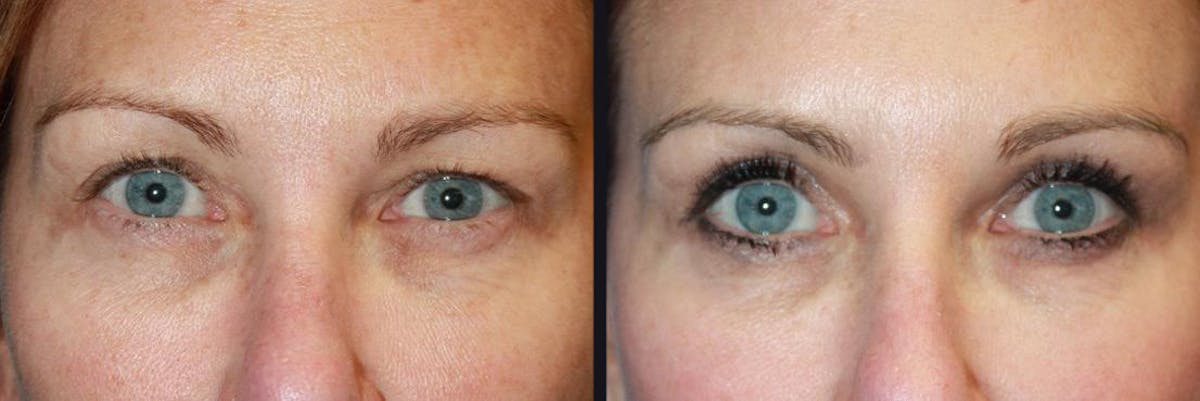 Blepharoplasty Before & After Gallery - Patient 177928380 - Image 1
