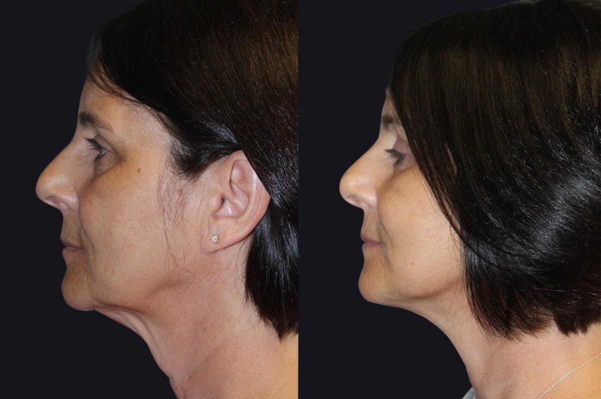 Facelift Before & After Gallery - Patient 177928379 - Image 1