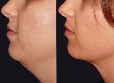 Neck Liposuction Before & After Gallery - Patient 177928363 - Image 1