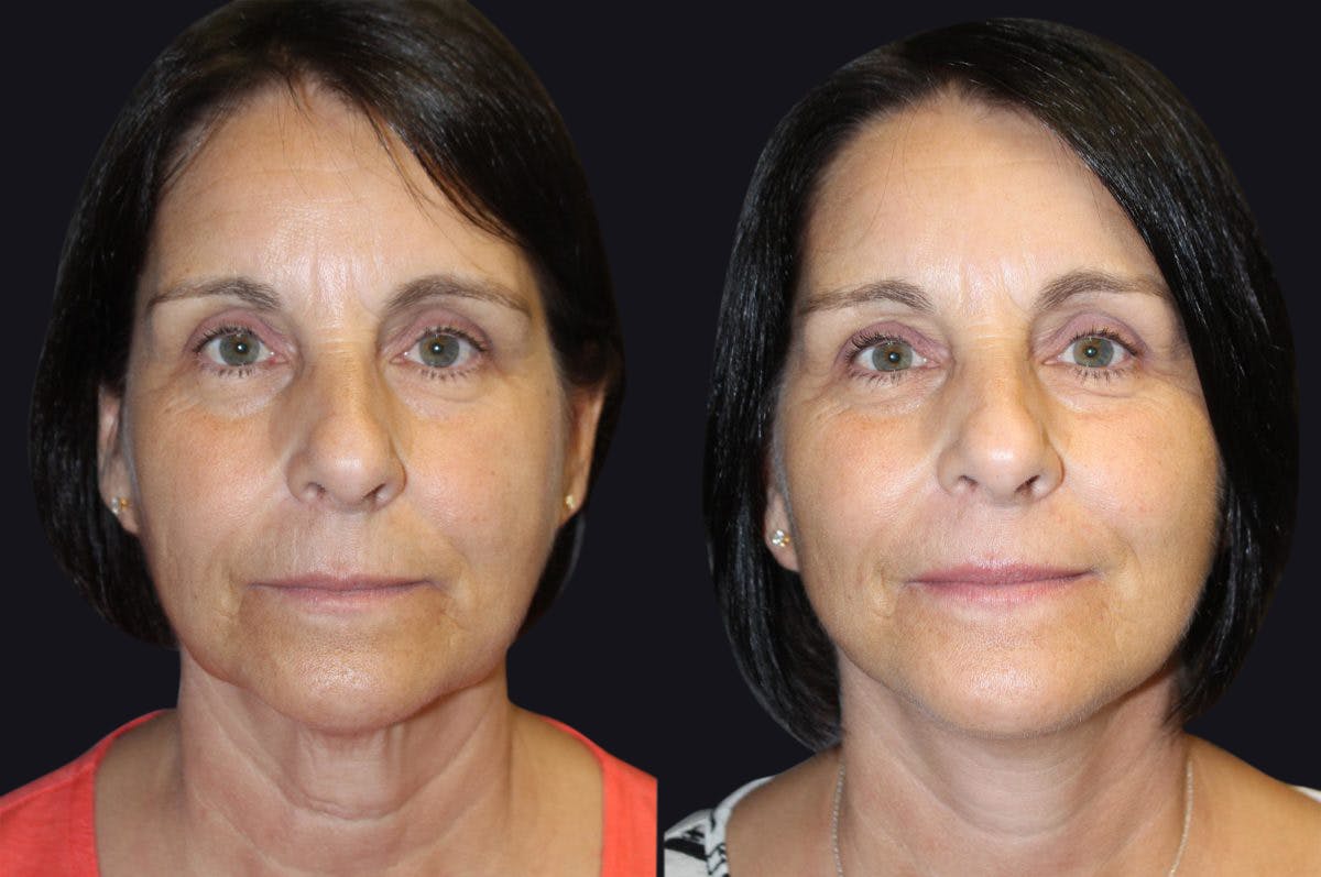 Facelift Before & After Gallery - Patient 177928379 - Image 2