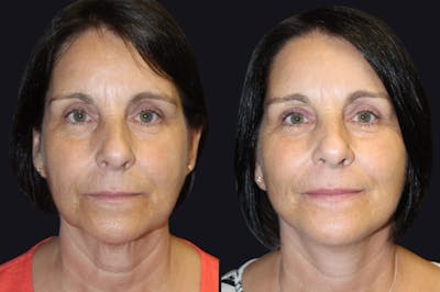 Facelift Before & After Gallery - Patient 177928379 - Image 1