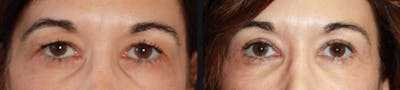 Blepharoplasty Before & After Gallery - Patient 177928360 - Image 1