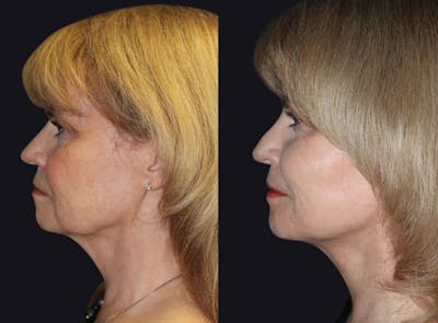 Facelift Before & After Gallery - Patient 177928325 - Image 1