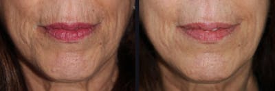 Microneedling Before & After Gallery - Patient 177928301 - Image 1