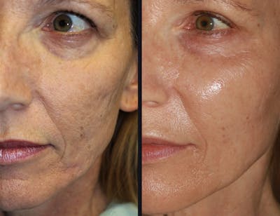 Microneedling Before & After Gallery - Patient 177928297 - Image 1