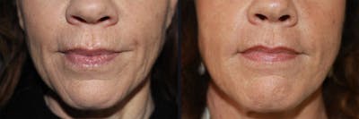 Microneedling Before & After Gallery - Patient 177928296 - Image 1