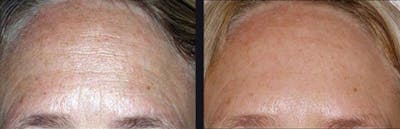 Microneedling Before & After Gallery - Patient 177928295 - Image 1