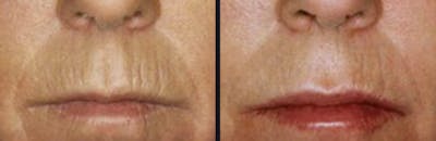 Microneedling Before & After Gallery - Patient 177928294 - Image 1